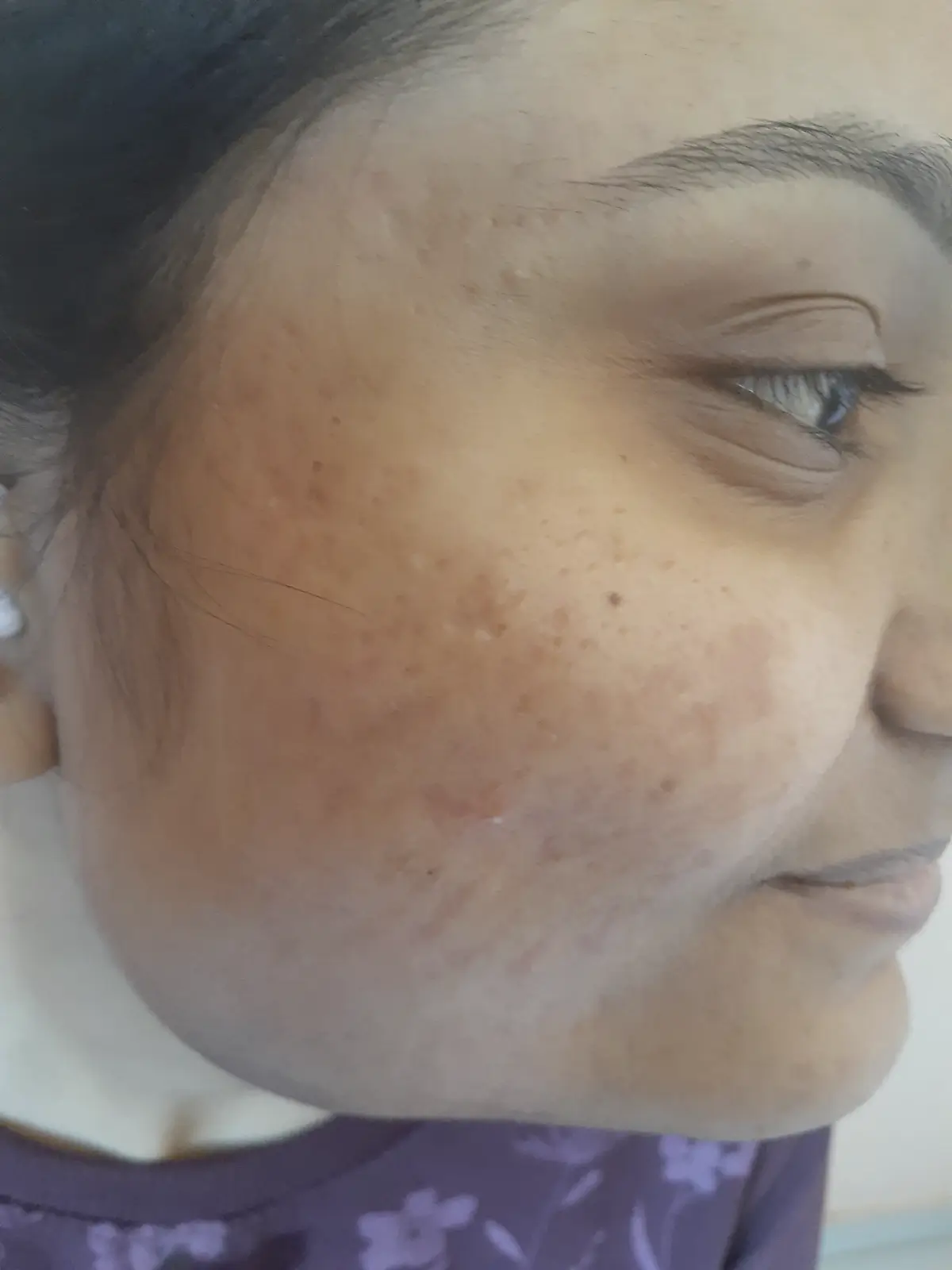 Other condition case 4 after treatment