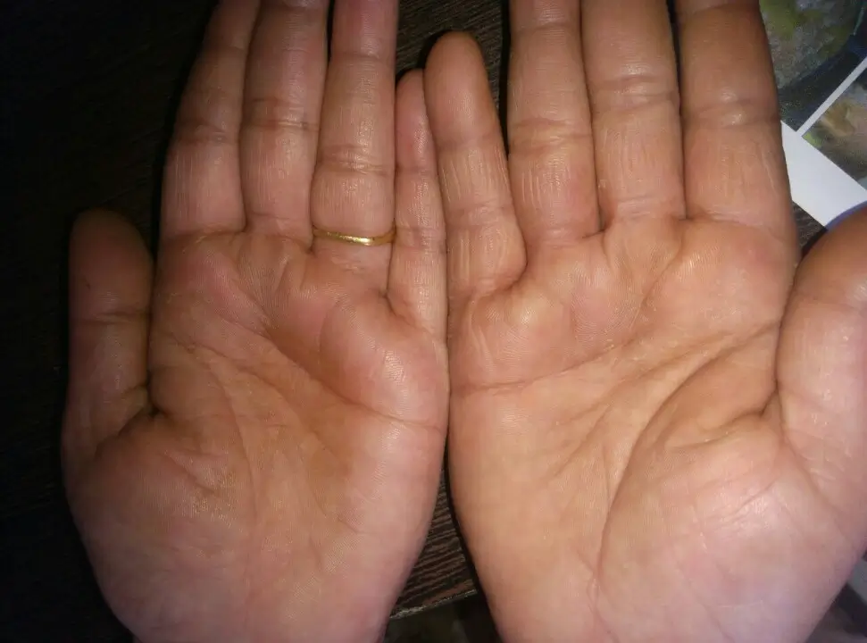 Other condition case 5 after treatment