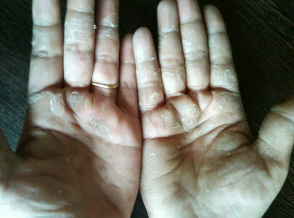 Other condition case 5 before treatment