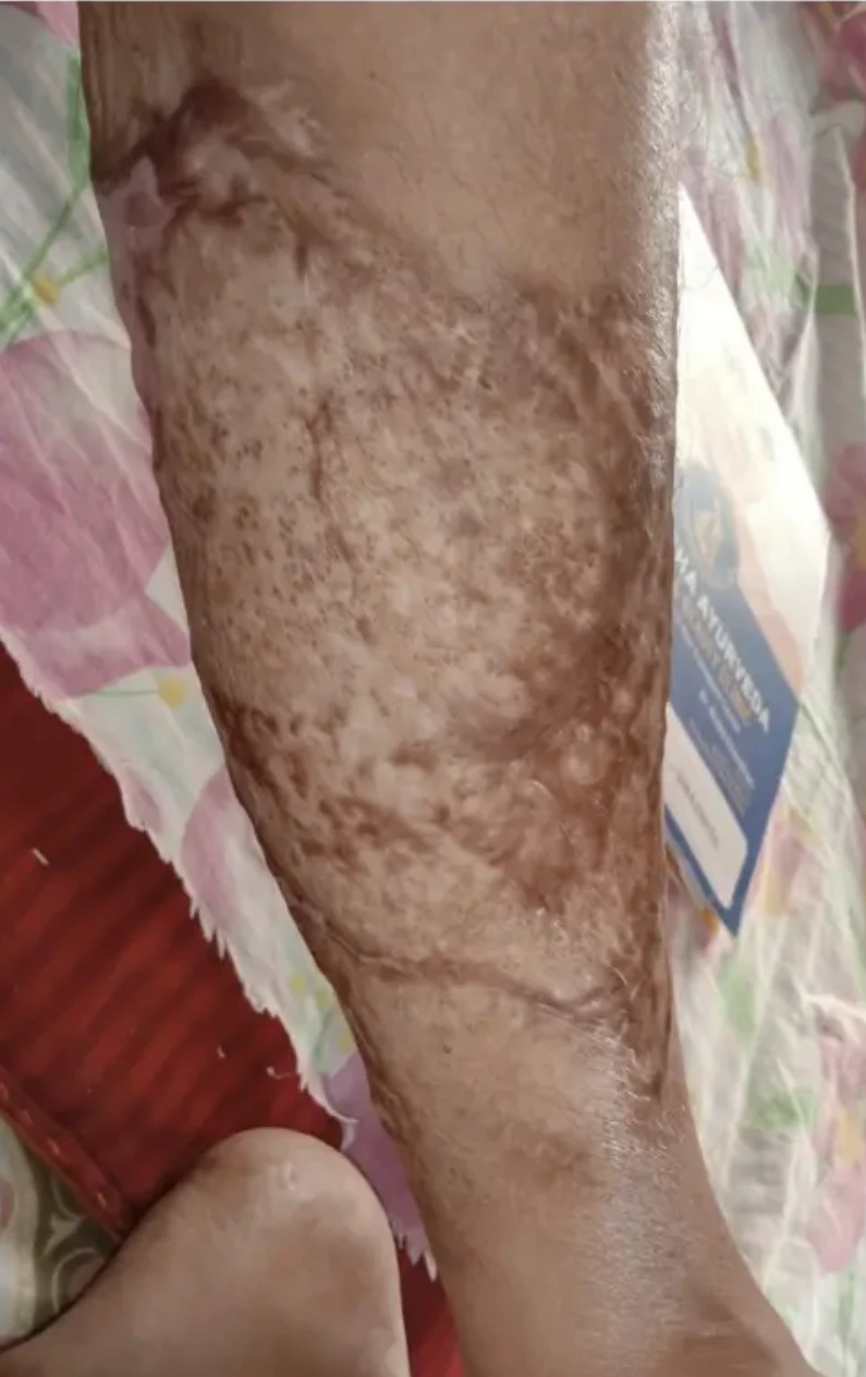 Other condition case 6 after treatment