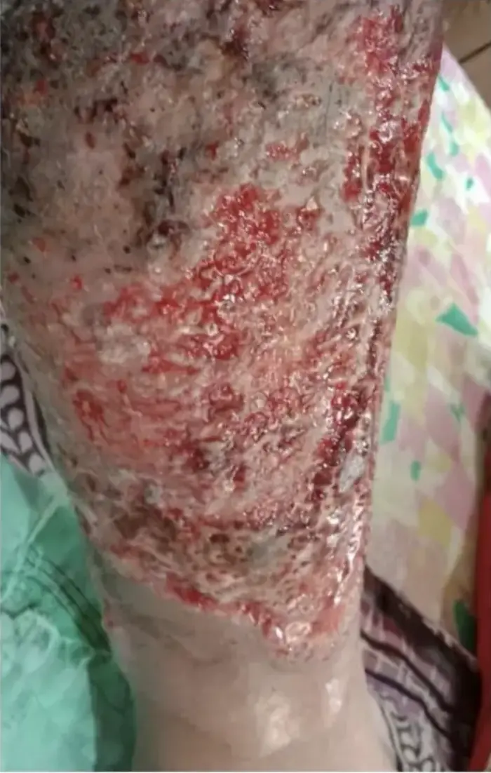 Other condition case 6 before treatment