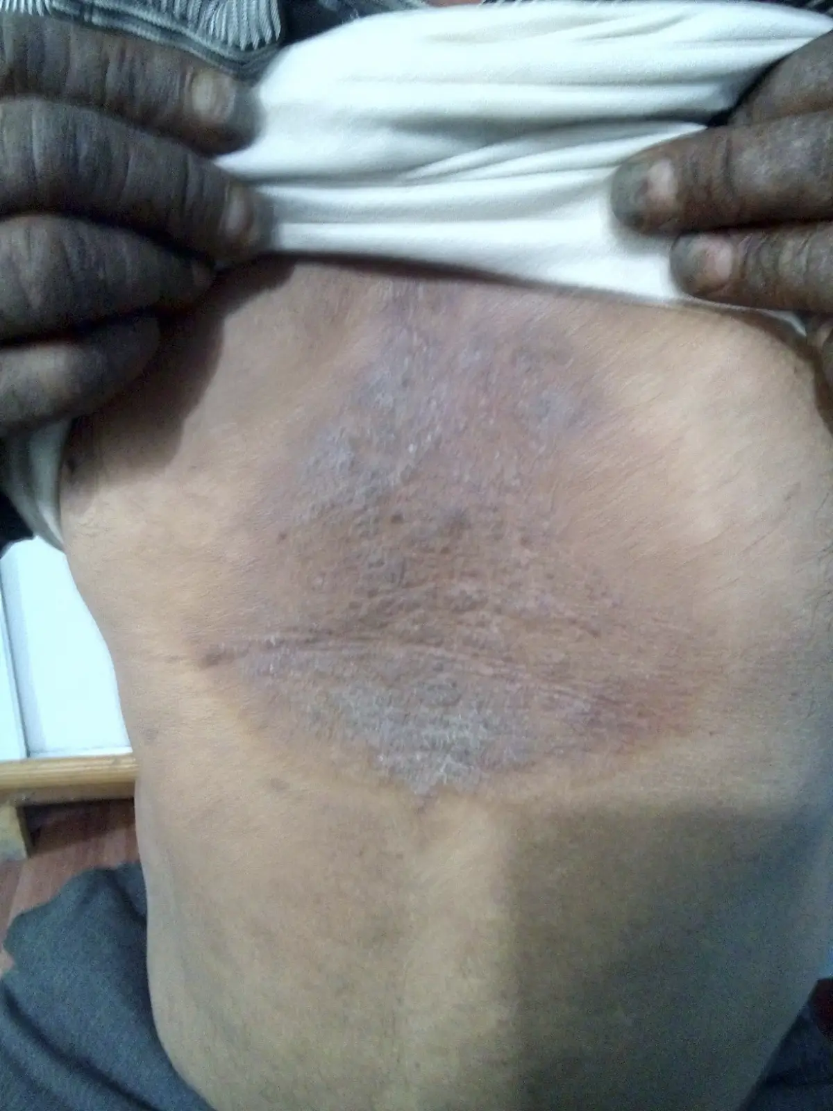 Psoriasis After