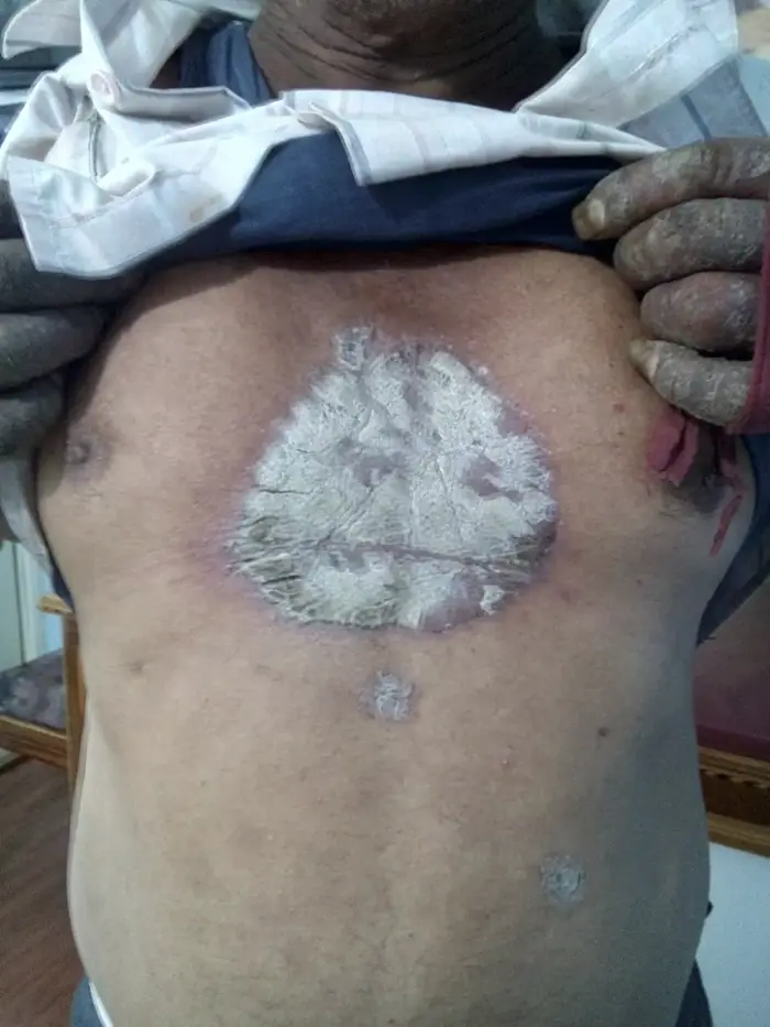 Psoriasis Before