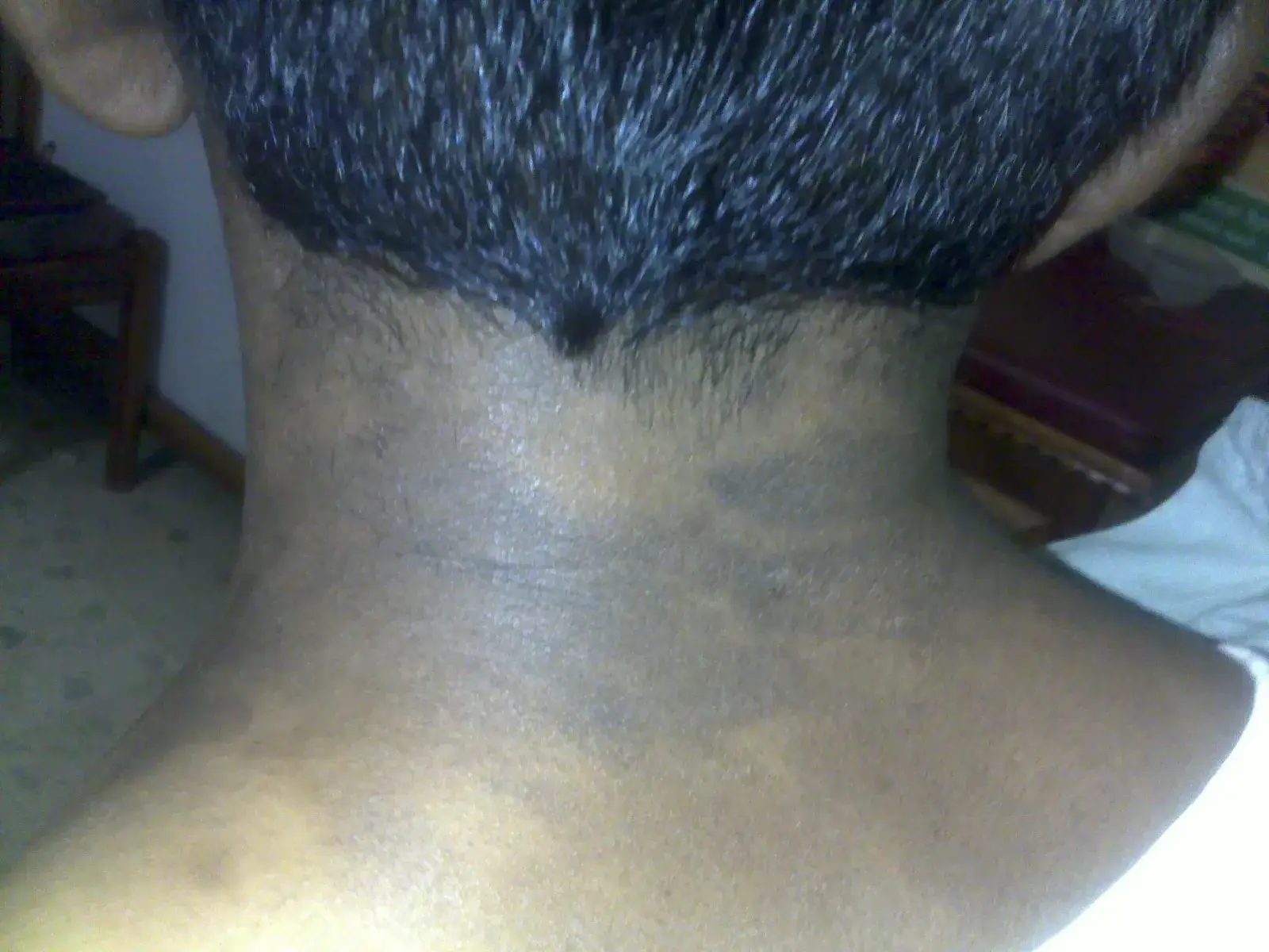 Psoriasis case 2 after treatment
