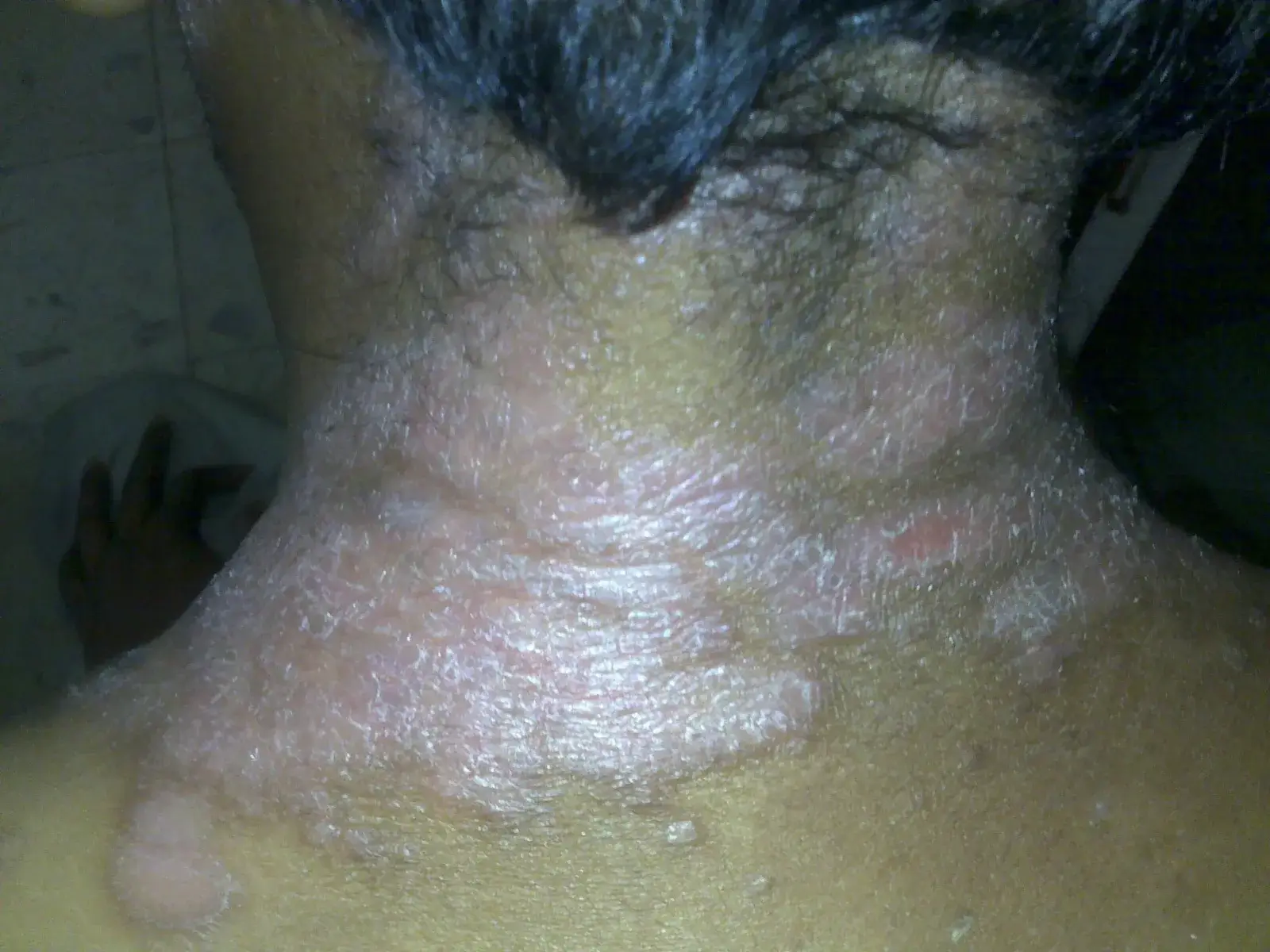 Psoriasis case 2 before treatment