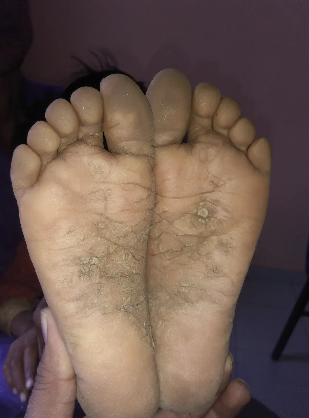 Psoriasis case 3 after treatment