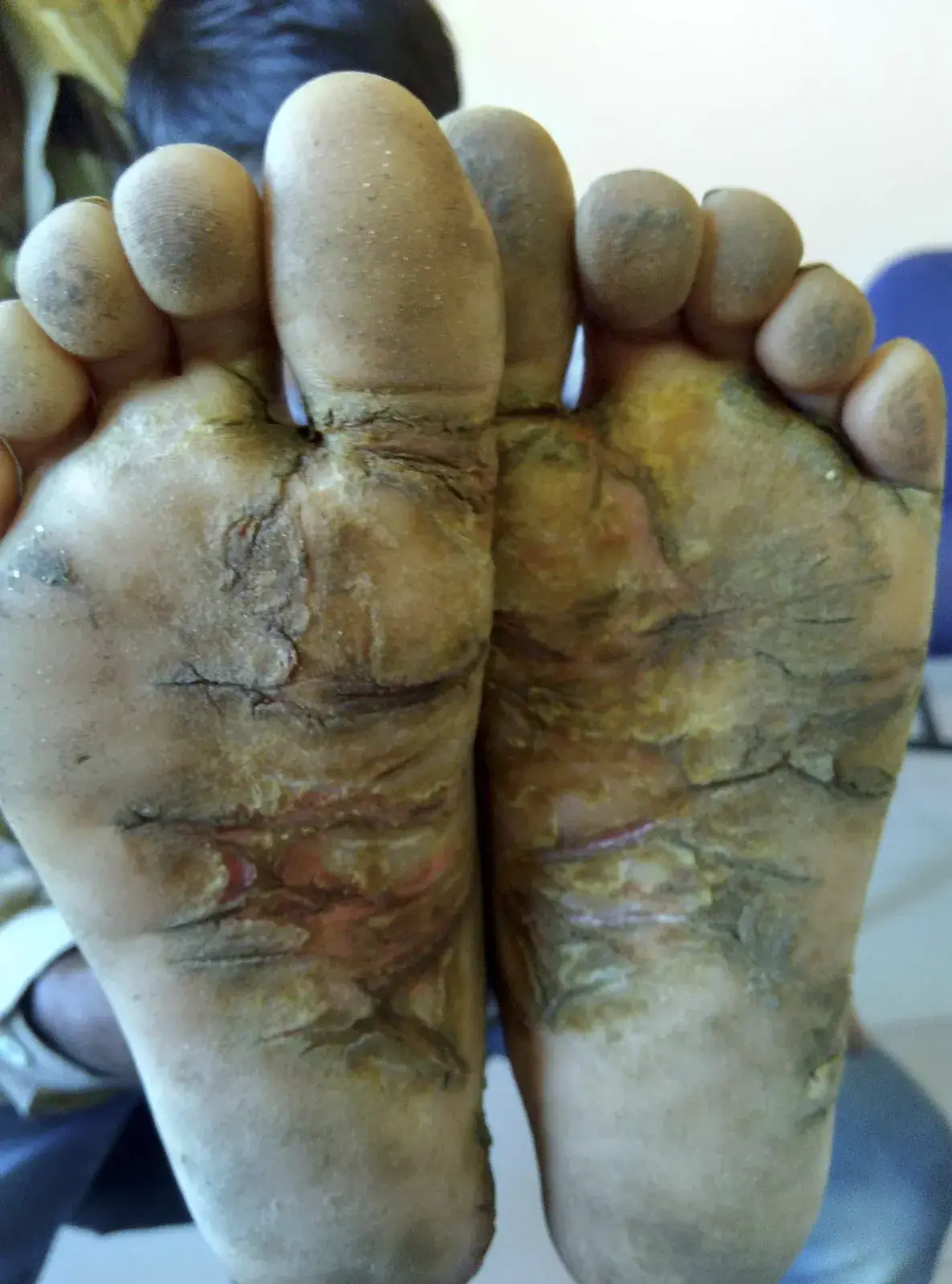 Psoriasis case 3 before treatment