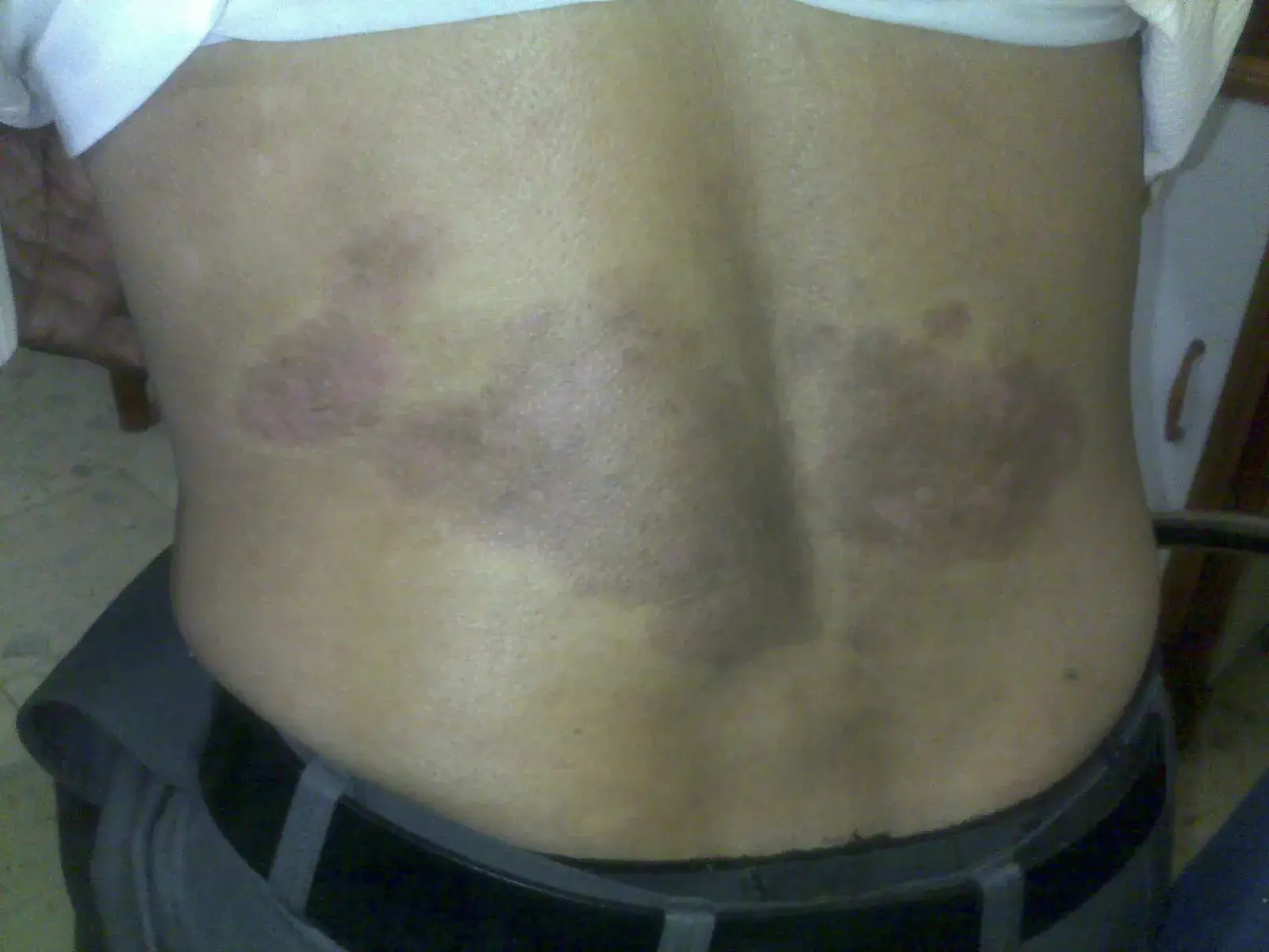 Psoriasis case 4 after treatment
