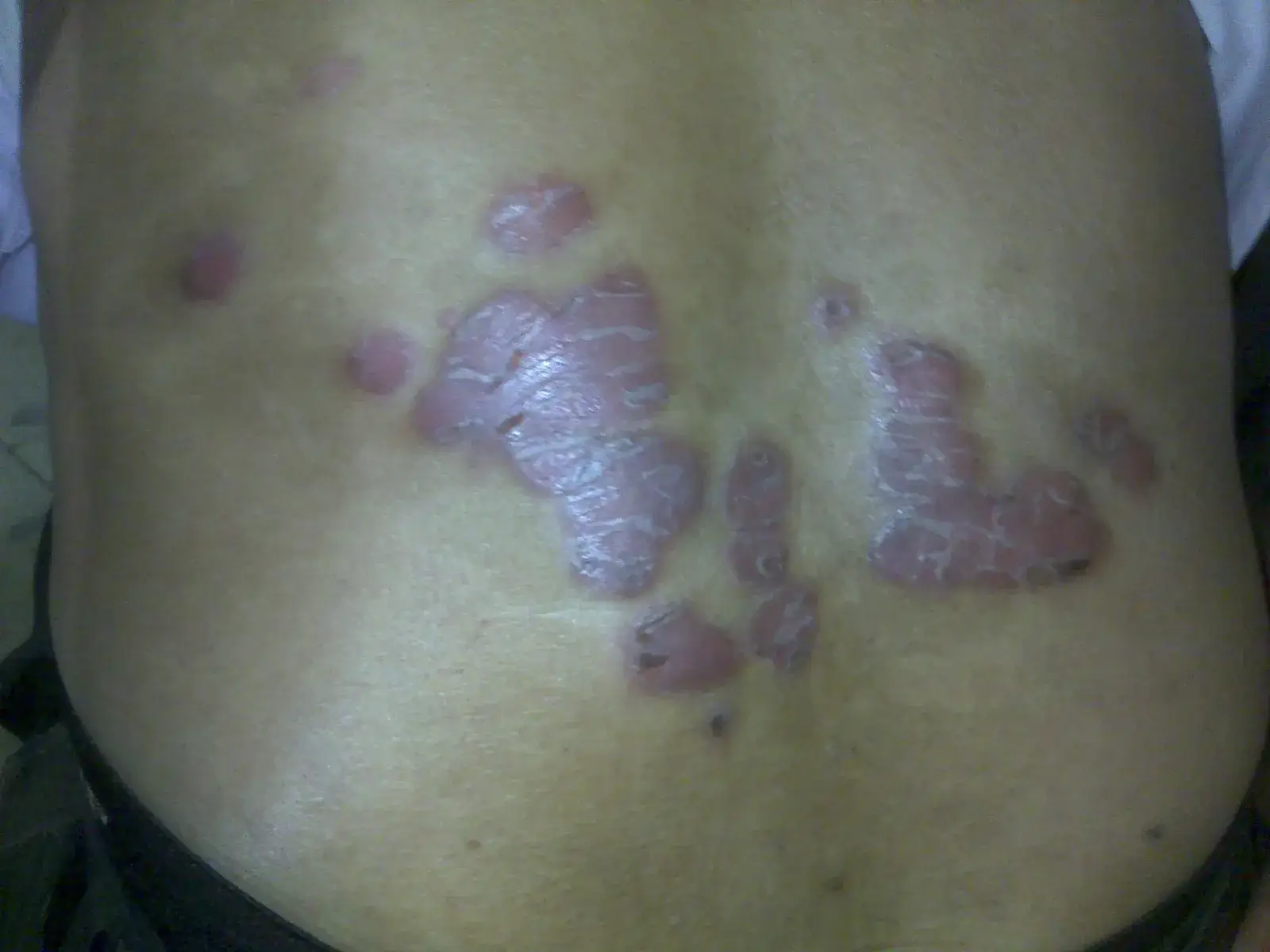 Psoriasis case 4 before treatment