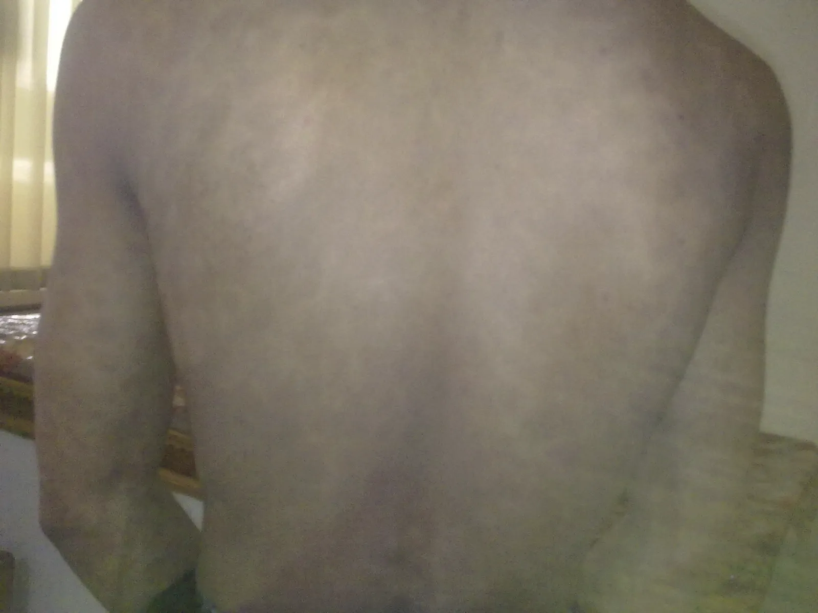 Psoriasis case 5 after treatment