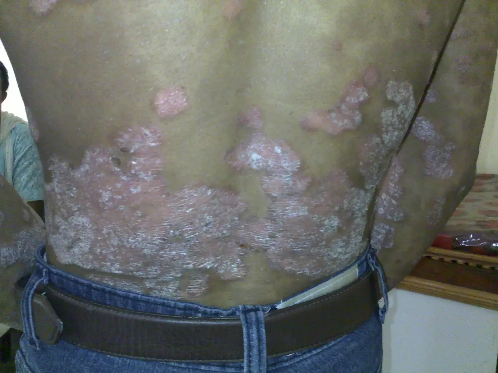 Psoriasis case 5 before treatment