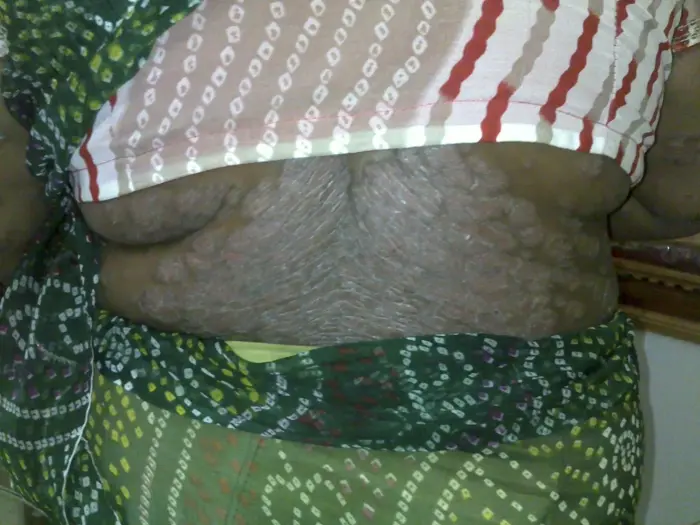 Psoriasis case 6 before treatment