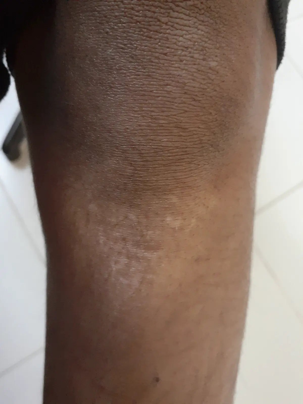 Vitiligo After
