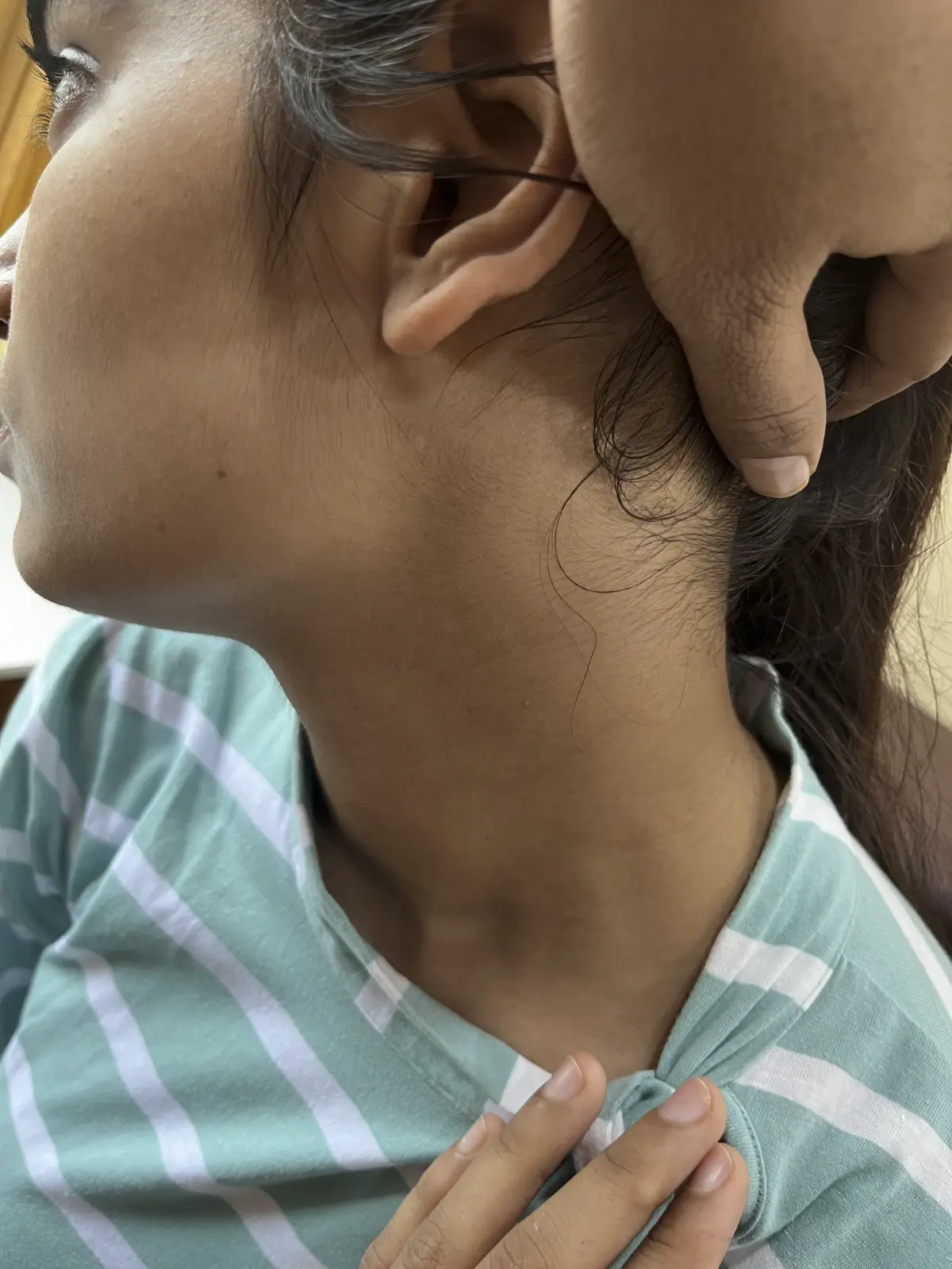 Vitiligo case 2 after treatment