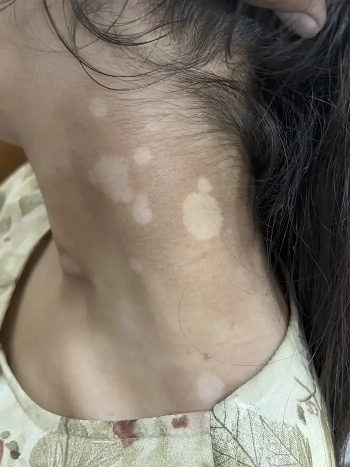 Vitiligo case 2 before treatment