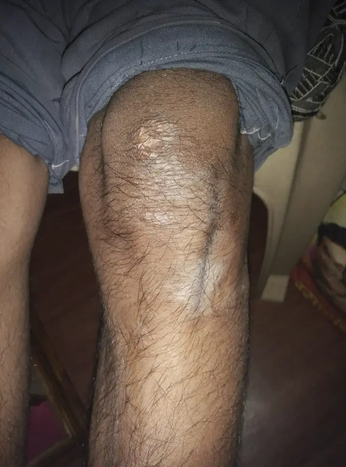 Vitiligo case 3 after treatment