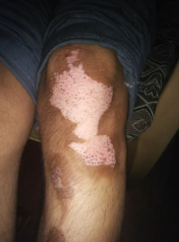 Vitiligo case 3 before treatment