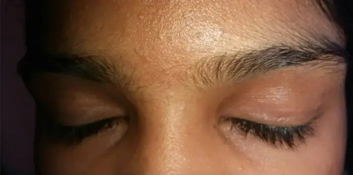 Vitiligo case 4 after treatment