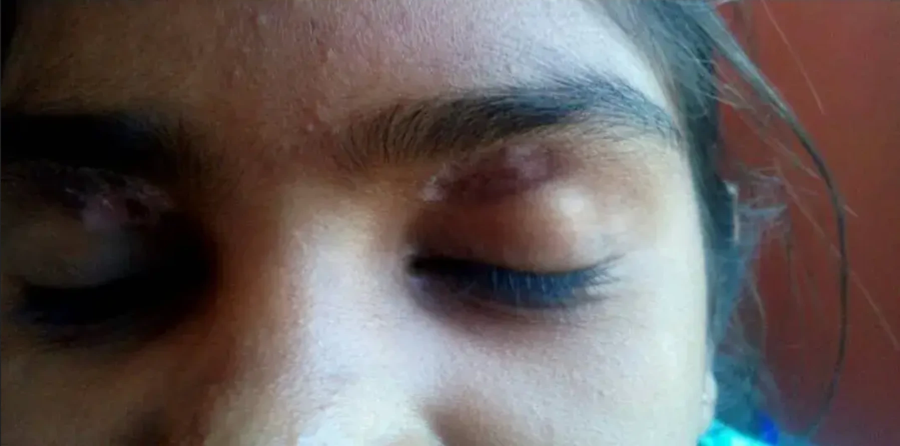 Vitiligo case 4 before treatment