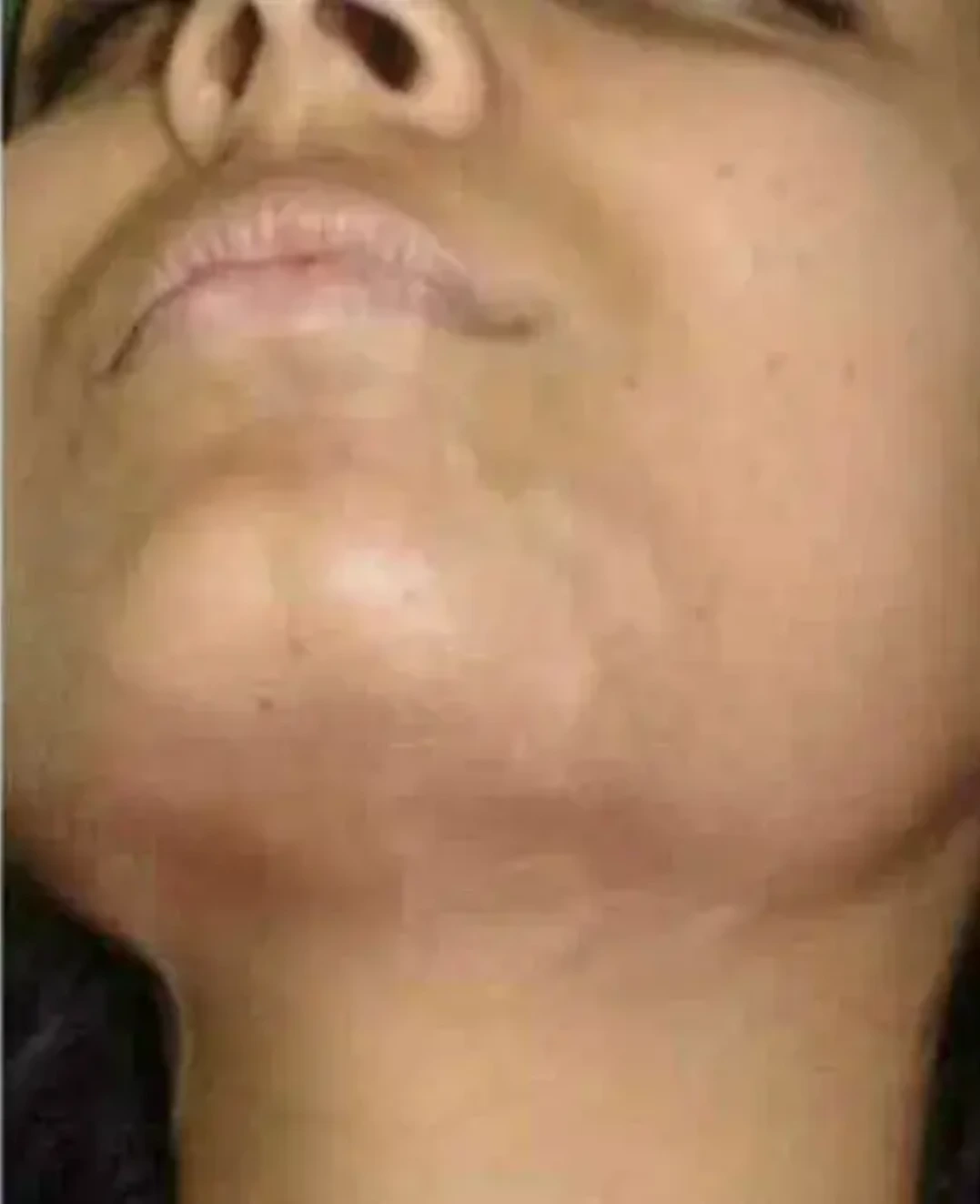 Vitiligo case 5 after treatment