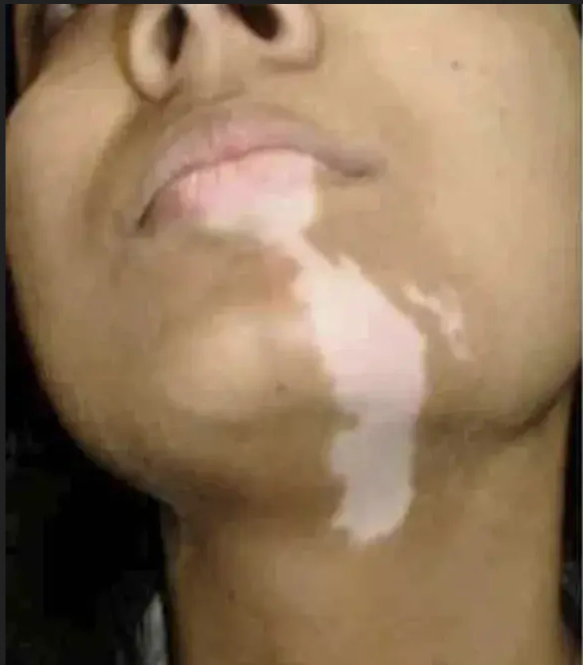 Vitiligo case 5 before treatment