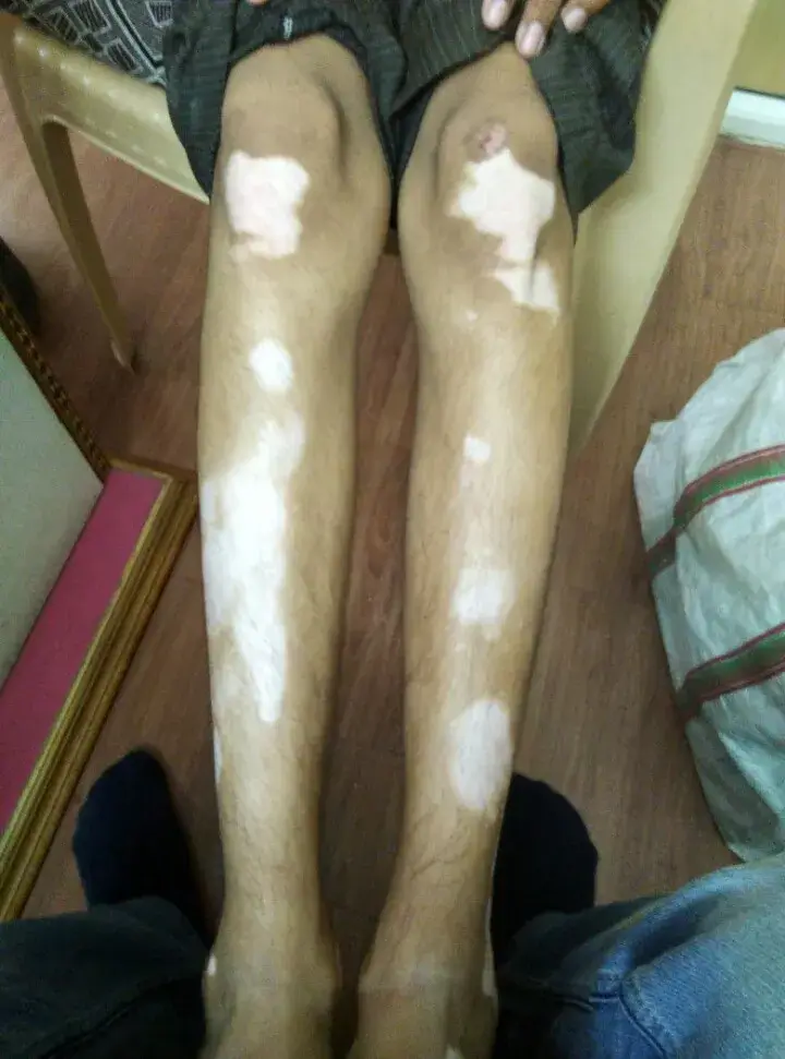 Vitiligo case 6 after treatment