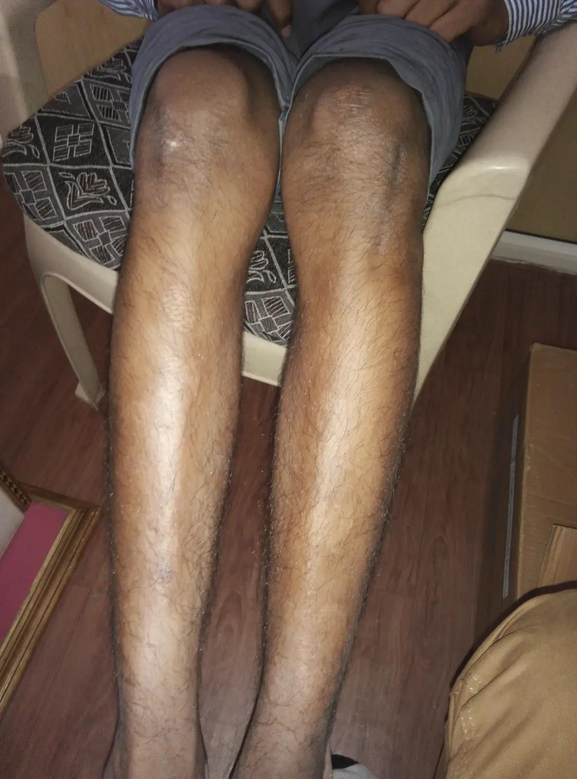 Vitiligo case 6 before treatment