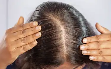 Female Pattern Hair Loss