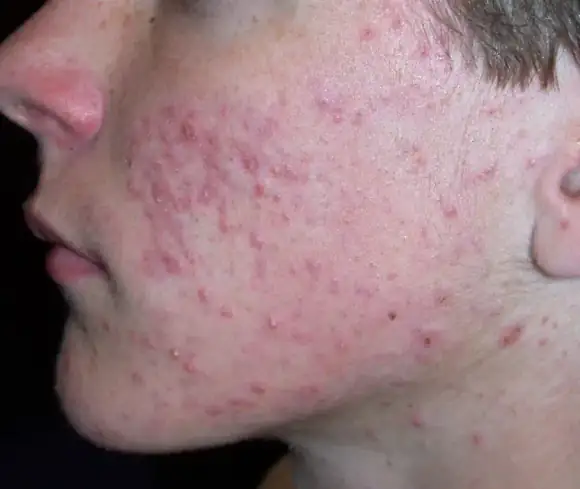 Acne & Dark Spots